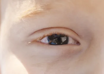 fotoceratite-exige-cuidados-redobrados-no-verao