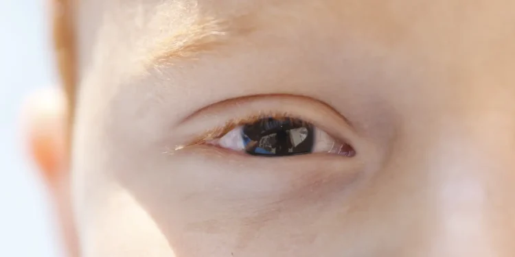 fotoceratite-exige-cuidados-redobrados-no-verao